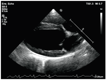 Right parasternal long axis